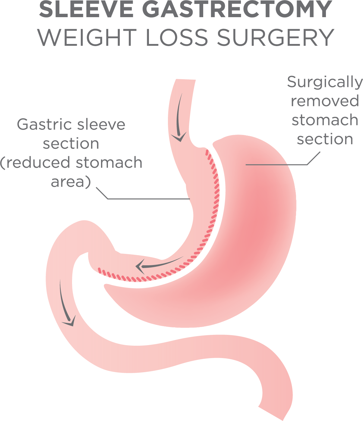 Size of the Stomach After Gastric Sleeve Surgery
